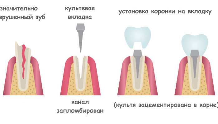 Без культевой вкладки невозможно поставить коронки