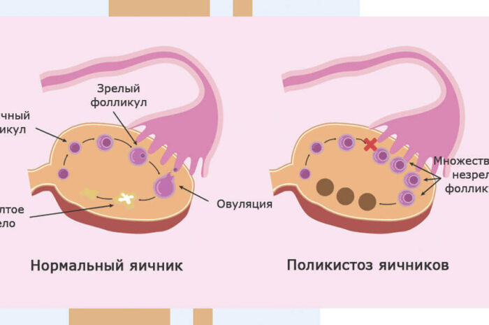 Дисфункция яичников. Симптоматика патологии