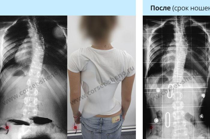 Лечение сколиоза с помощью корсета Шено