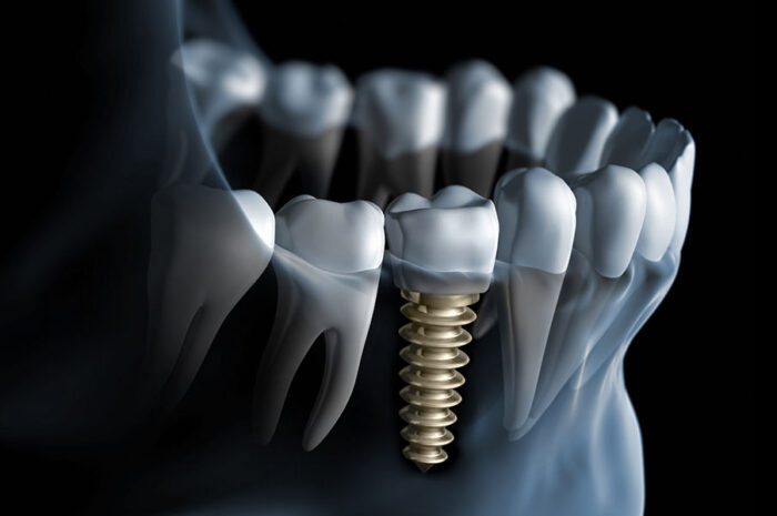 Ледяное покрытие поможет имплантатам лучше прижиться в организме