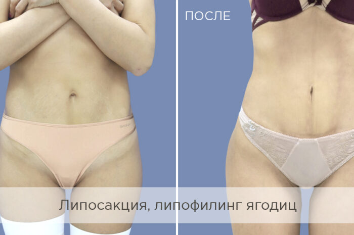Пластическая хирургия для лица и тела: липосакция и липофилинг