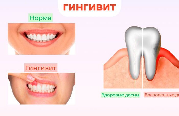 Подробнее о гингивите