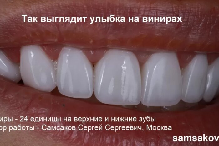 Виниры сегодня востребованы в стоматологии